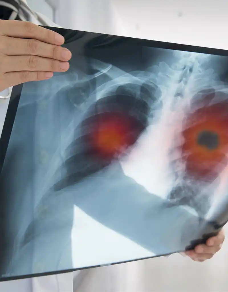 Studie lungcancer